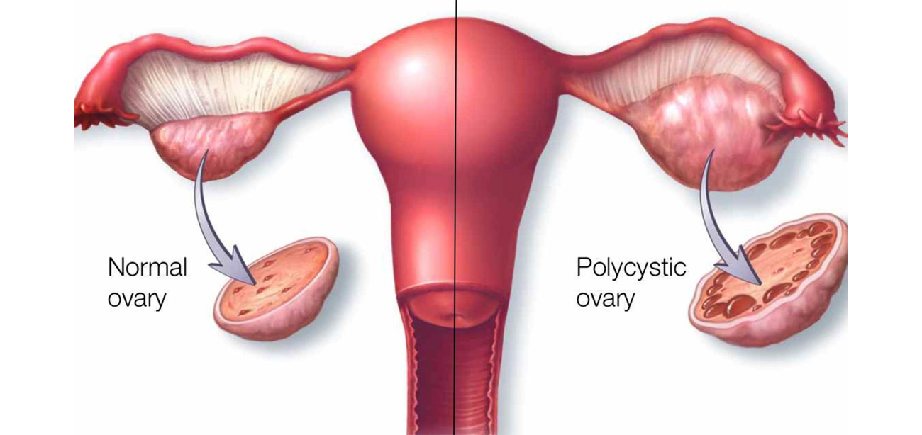 PCOD Disorders