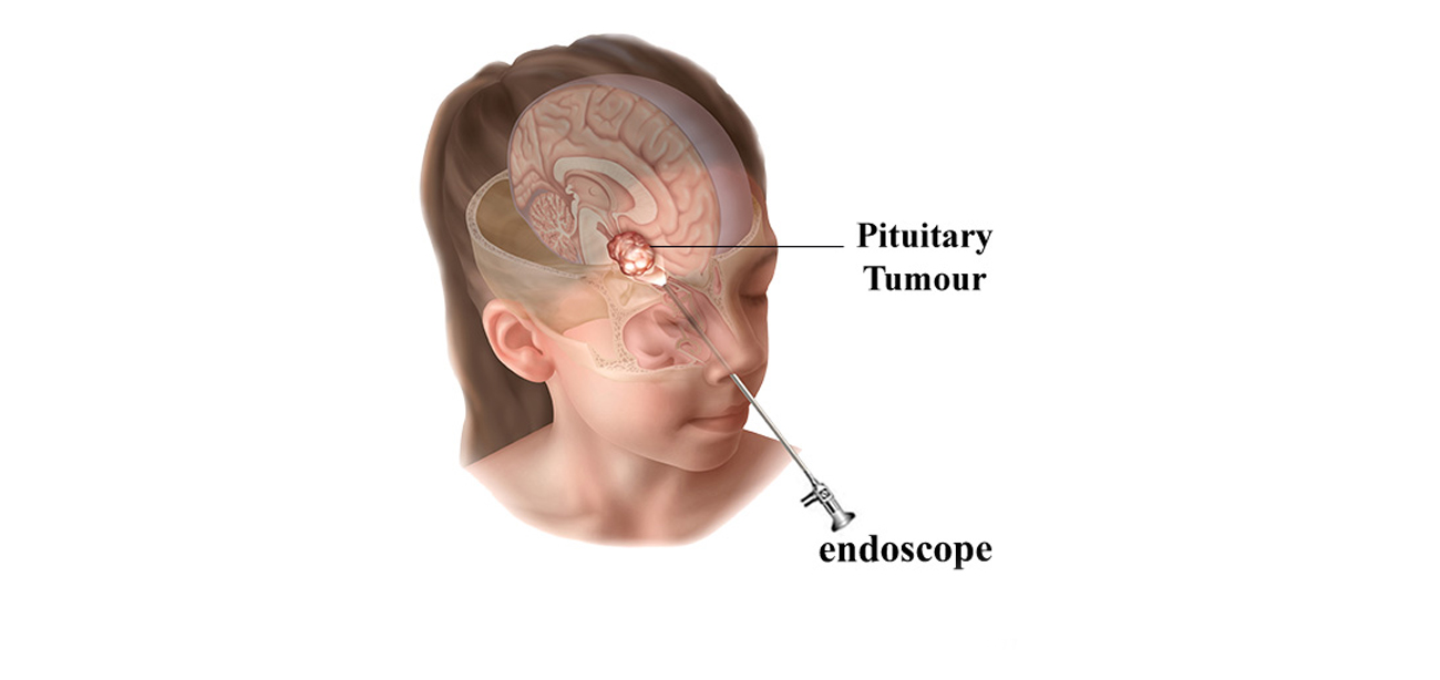 Thyroid Disorders